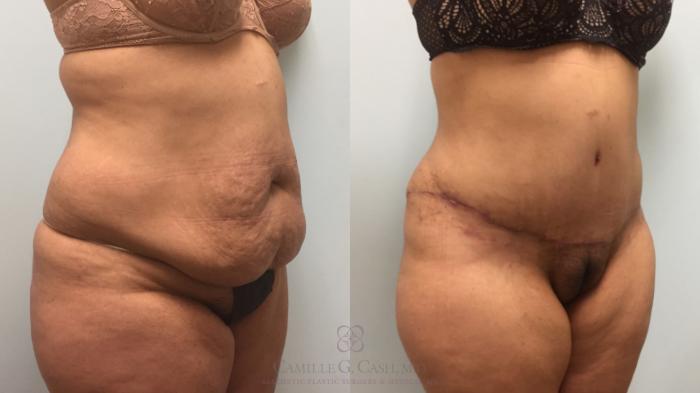 Before & After Tummy Tuck Case 616 Left Oblique View in Houston, TX