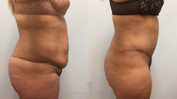 Before & After Tummy Tuck Case 616 Left Side View in Houston, TX