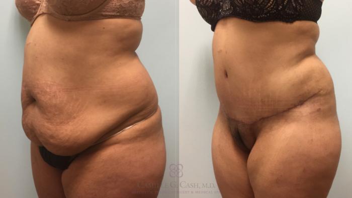 Before & After Tummy Tuck Case 616 Right Oblique View in Houston, TX