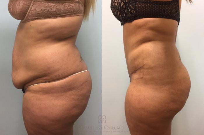 Before & After Tummy Tuck Case 616 Right Side View in Houston, TX