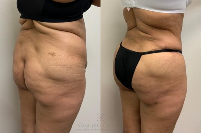 Before & After Brazilian Butt Lift Case 617 back oblique 2 View in Houston, TX