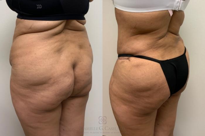 Before & After Brazilian Butt Lift Case 617 back oblique View in Houston, TX