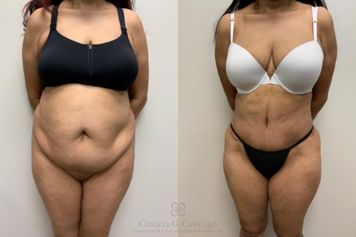 Before & After Brazilian Butt Lift Case 617 Front View in Houston, TX