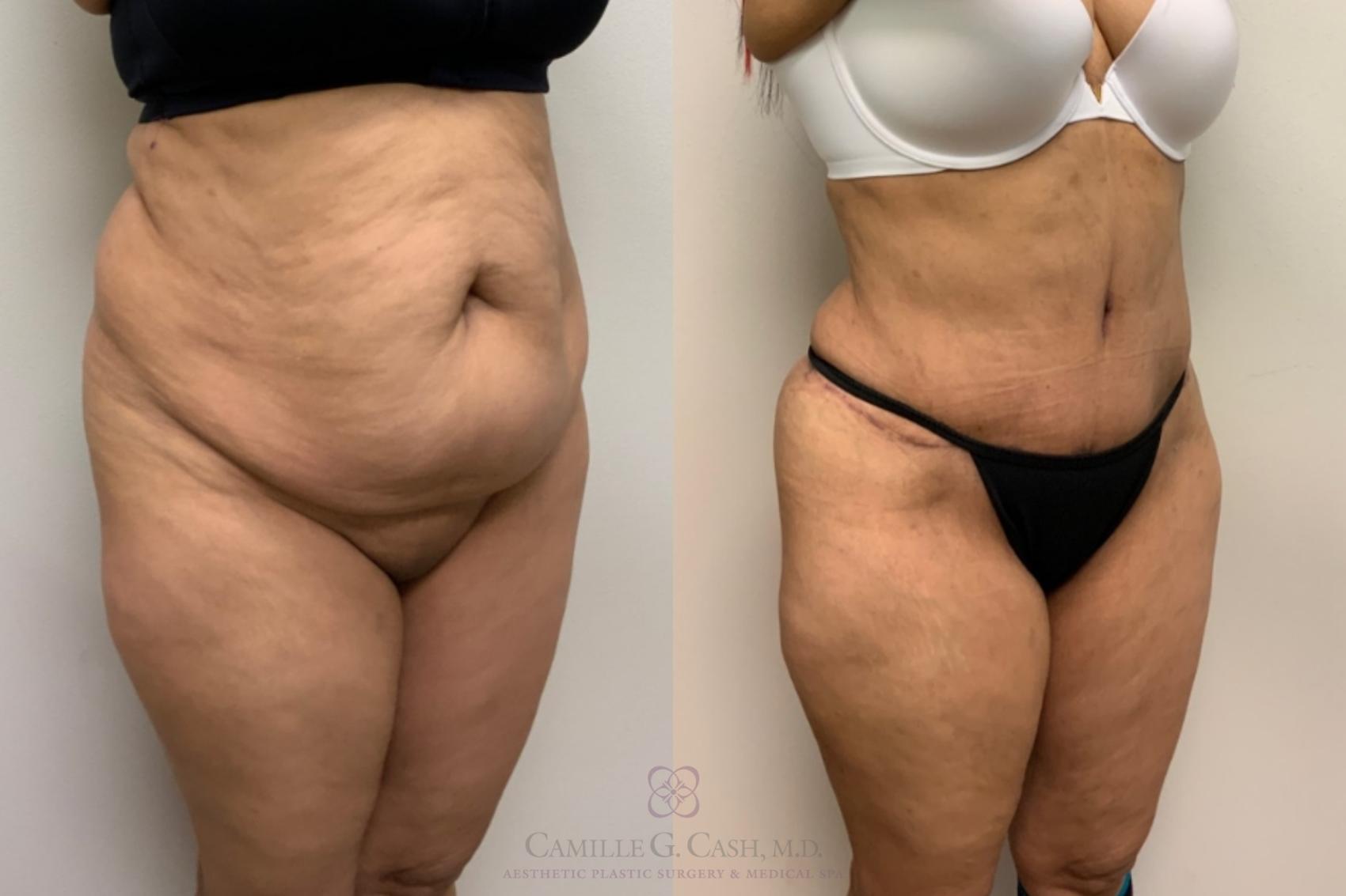 Before & After Tummy Tuck Case 617 Left Oblique View in Houston, TX