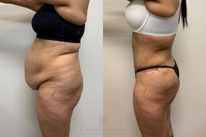 Before & After Brazilian Butt Lift Case 617 Right Side View in Houston, TX