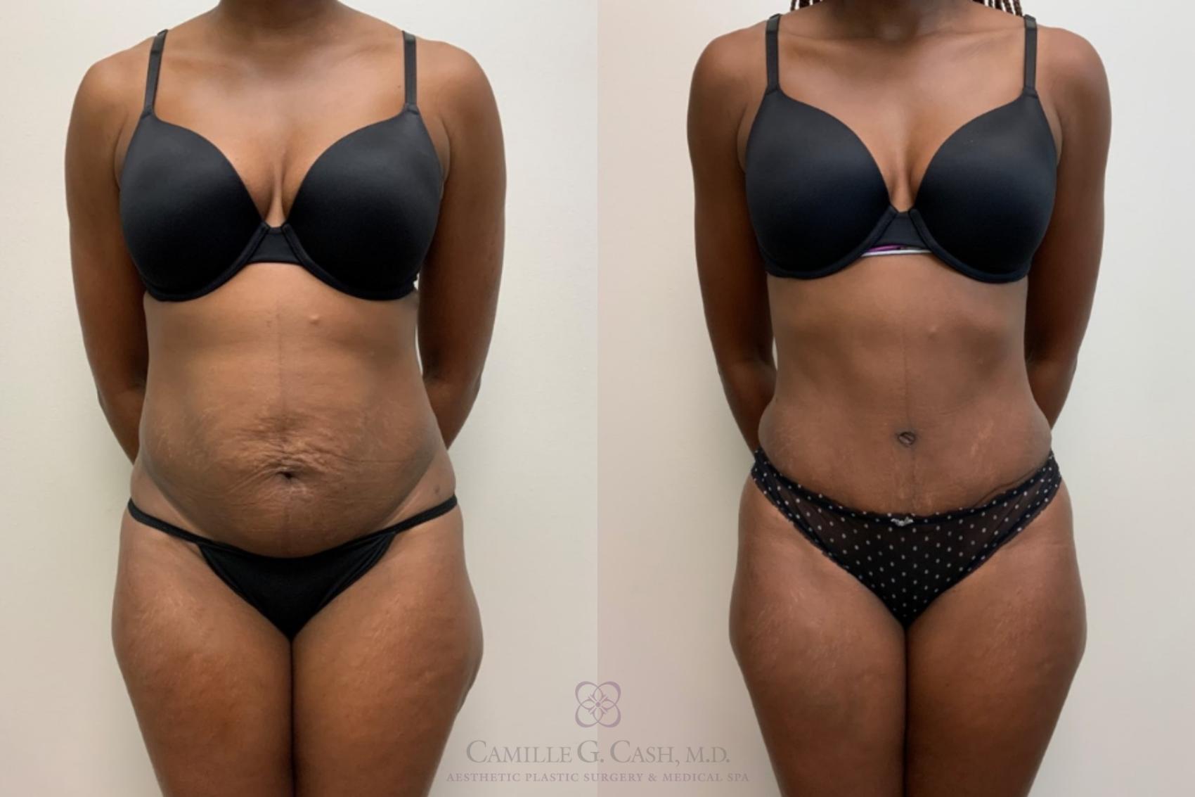 Before & After Tummy Tuck Case 618 Front View in Houston, TX
