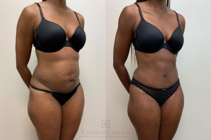 Before & After Tummy Tuck Case 618 Left Oblique View in Houston, TX