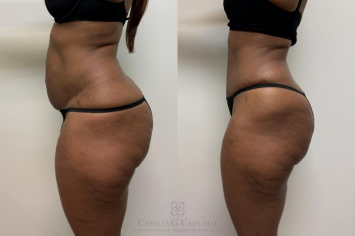 Before & After Tummy Tuck Case 618 Left Side View in Houston, TX