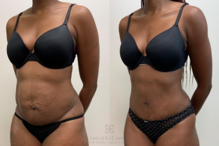 Before & After Tummy Tuck Case 618 Right Oblique View in Houston, TX