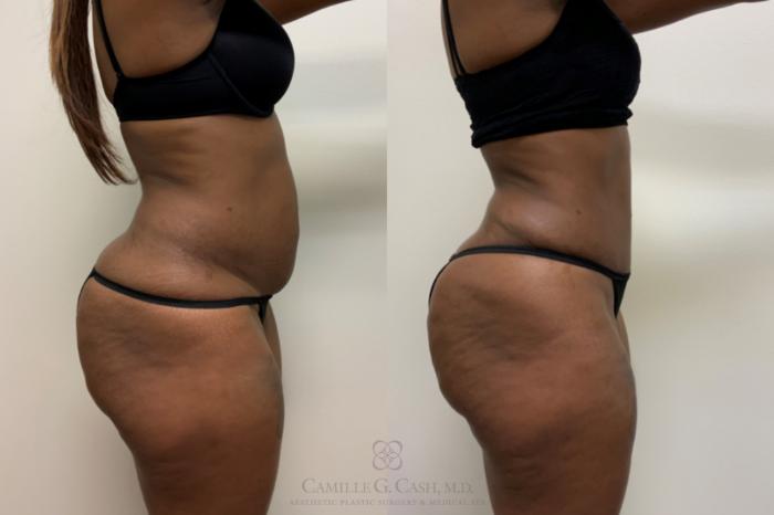 Before & After Tummy Tuck Case 618 Right Side View in Houston, TX