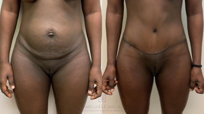 Before & After Tummy Tuck Case 622 Front View in Houston, TX