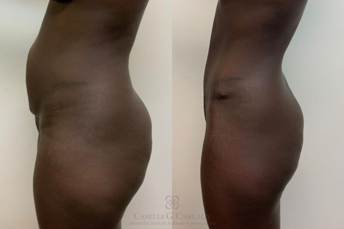 Before & After Tummy Tuck Case 622 Left Side View in Houston, TX