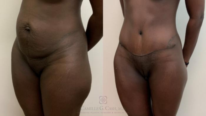 Before & After Tummy Tuck Case 622 Right Oblique View in Houston, TX