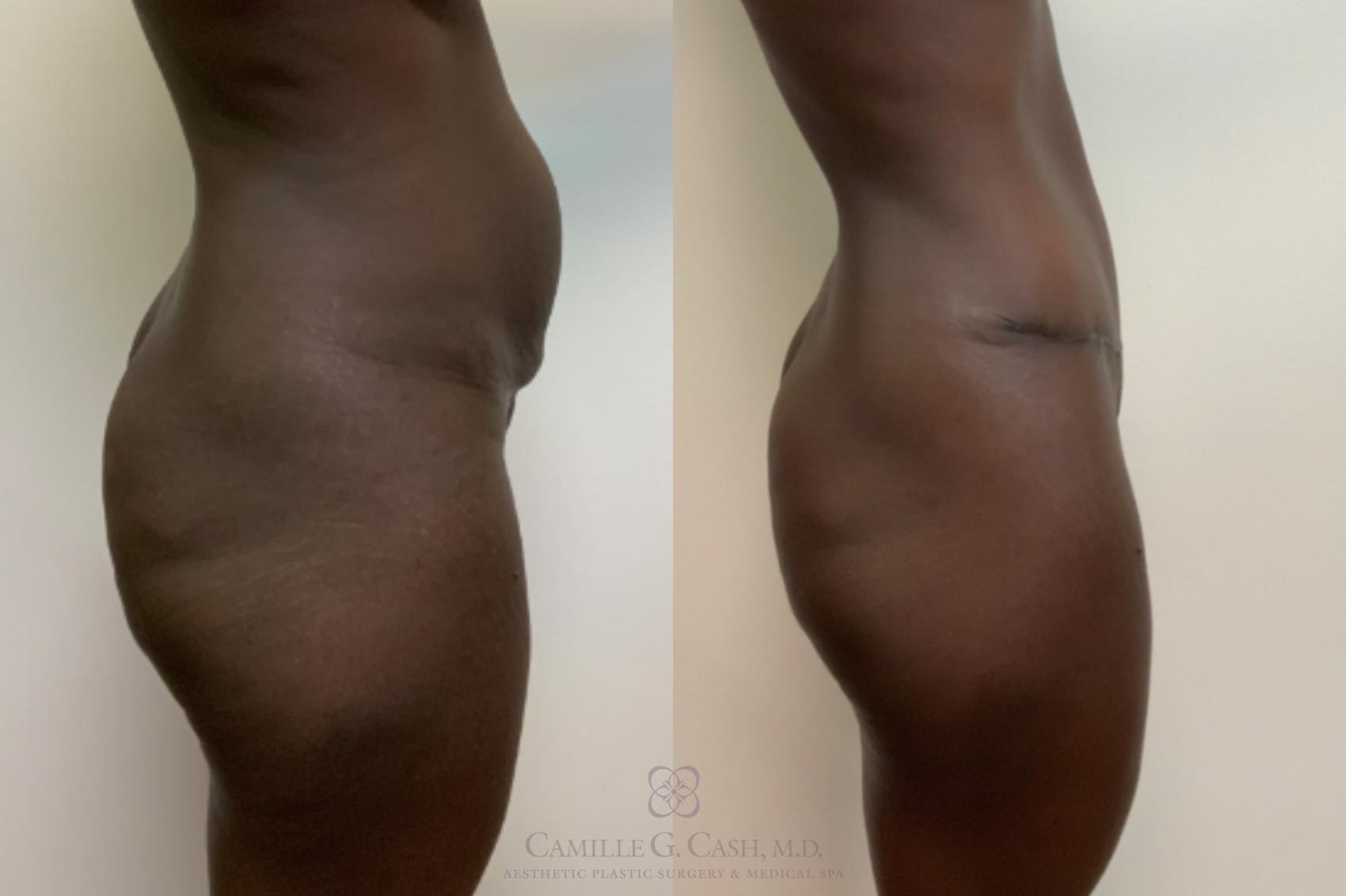 Before & After Tummy Tuck Case 622 Right Side View in Houston, TX
