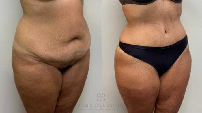 Before & After Tummy Tuck Case 632 6 month oblique View in Houston, TX