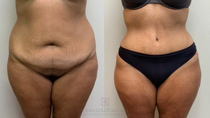 Before & After Tummy Tuck Case 632 6 months front View in Houston, TX