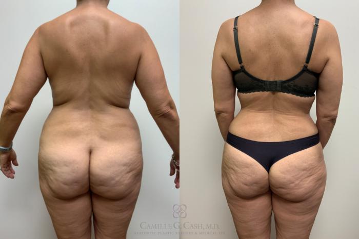 Before & After Tummy Tuck Case 632 Back View in Houston, TX