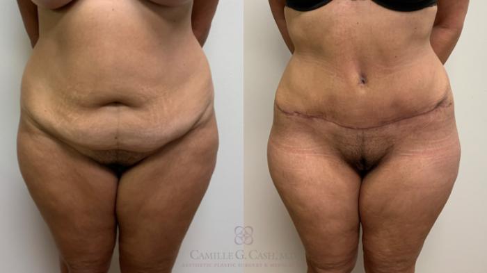 Before & After Tummy Tuck Case 632 front 2 View in Houston, TX