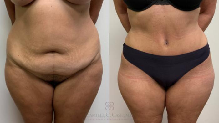 Before & After Tummy Tuck Case 632 Front View in Houston, TX