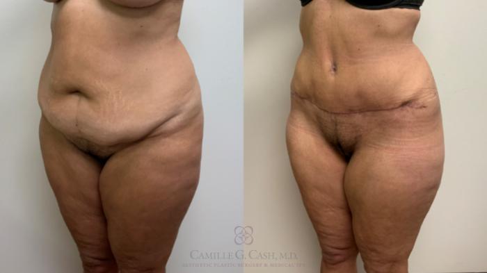 Before & After Tummy Tuck Case 632 Left Oblique View in Houston, TX