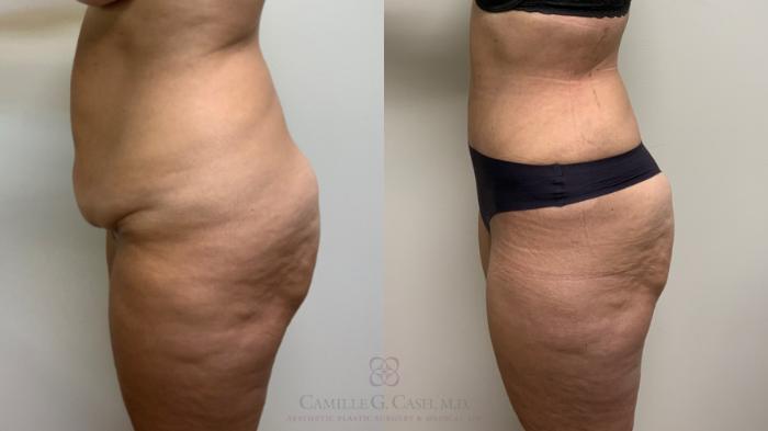 Before & After Tummy Tuck Case 632 Left Side View in Houston, TX