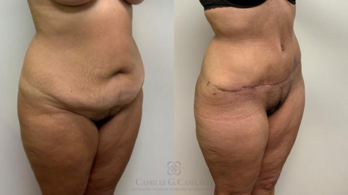 Before & After Tummy Tuck Case 632 Right Oblique View in Houston, TX