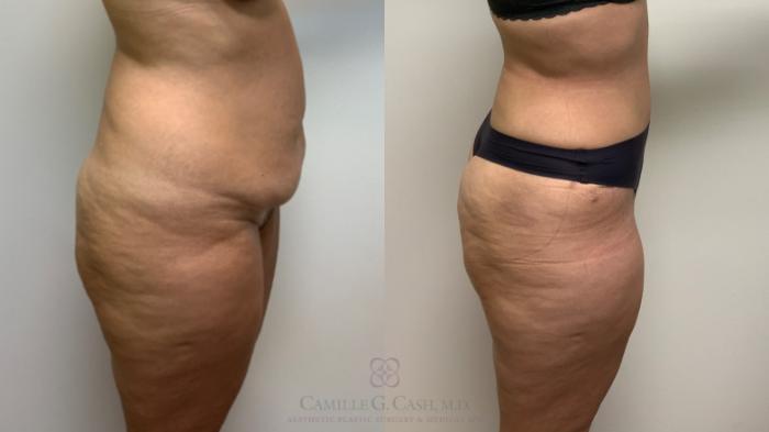 Before & After Tummy Tuck Case 632 Right Side View in Houston, TX