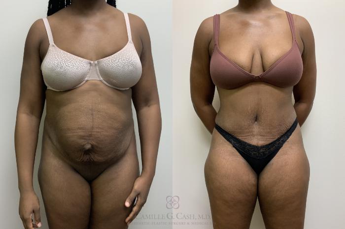Before & After Tummy Tuck Case 635 Front View in Houston, TX