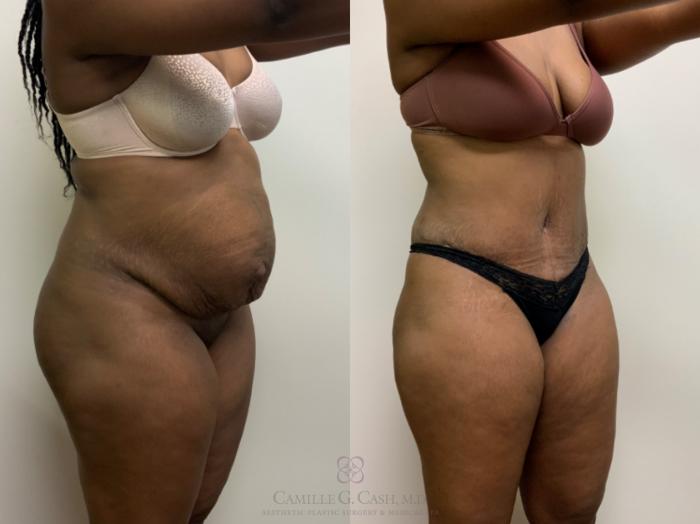Before & After Tummy Tuck Case 635 Left Oblique View in Houston, TX
