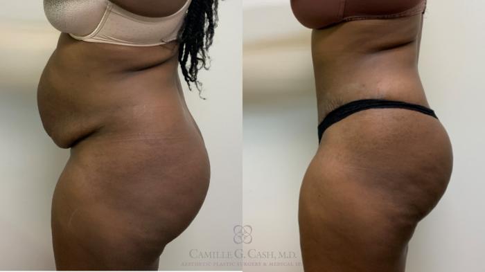 Before & After Tummy Tuck Case 635 Left Side View in Houston, TX