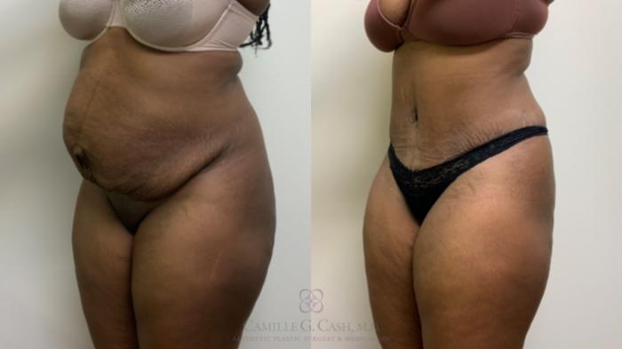 Before & After Tummy Tuck Case 635 Right Oblique View in Houston, TX