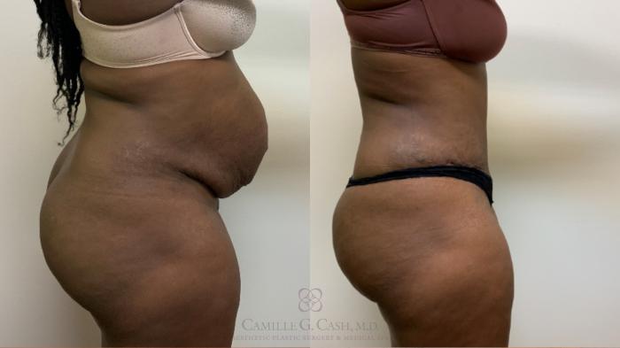 Before & After Tummy Tuck Case 635 Right Side View in Houston, TX