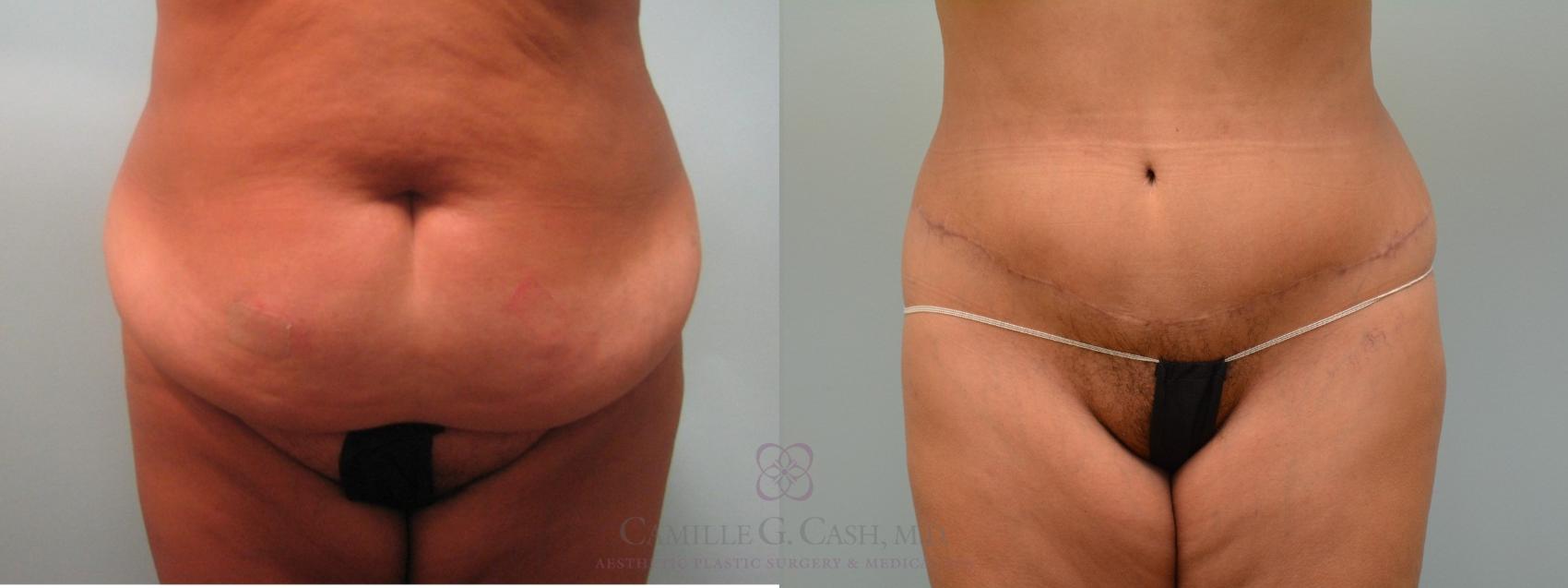 Before & After Tummy Tuck Case 64 Front View in Houston, TX