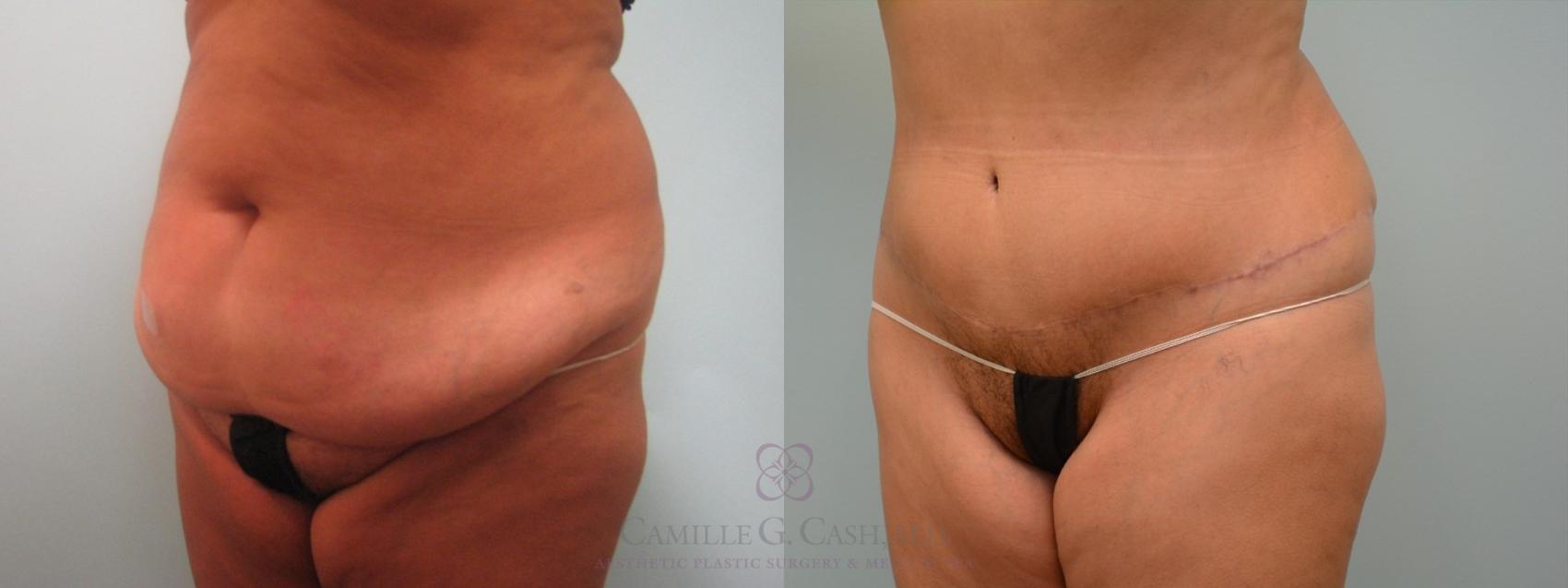 Before & After Tummy Tuck Case 64 Left Oblique View in Houston, TX