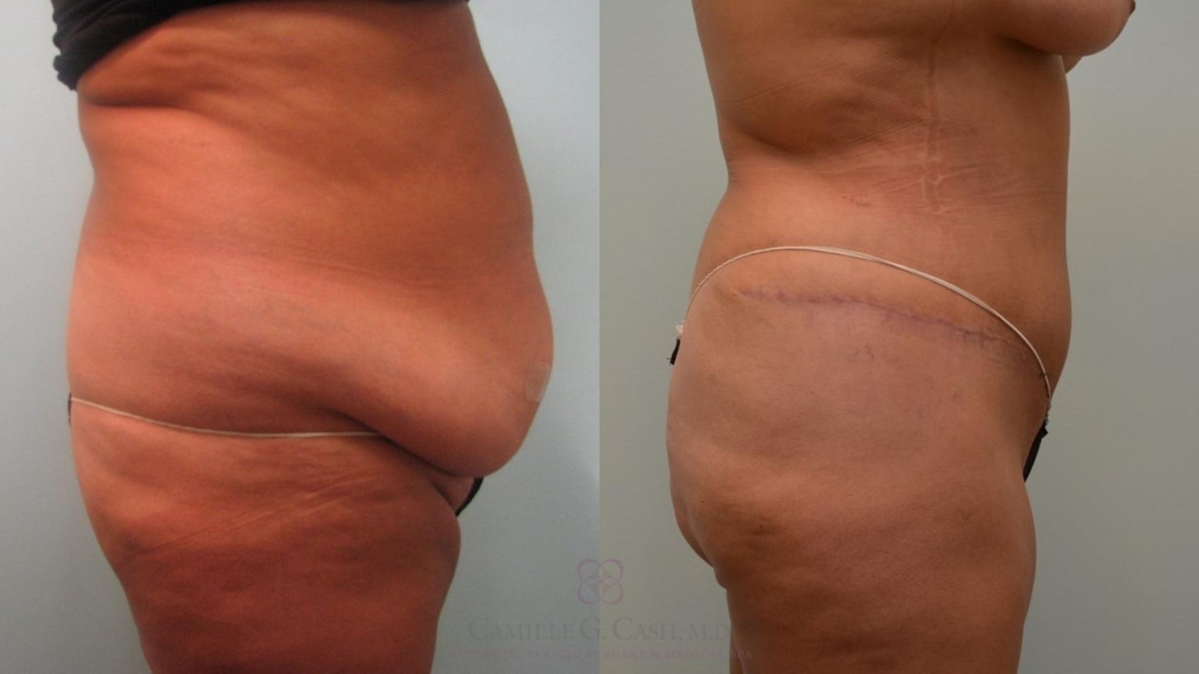 Before & After Tummy Tuck Case 64 Left Side View in Houston, TX