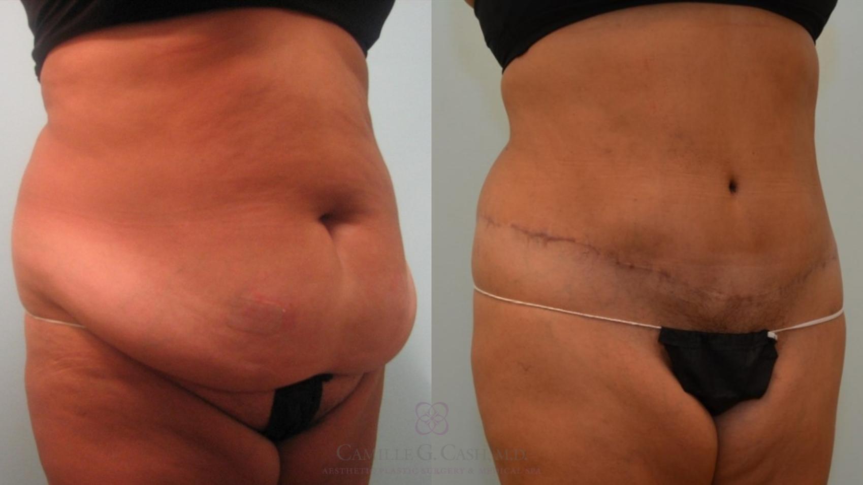 Before & After Tummy Tuck Case 64 Right Oblique View in Houston, TX