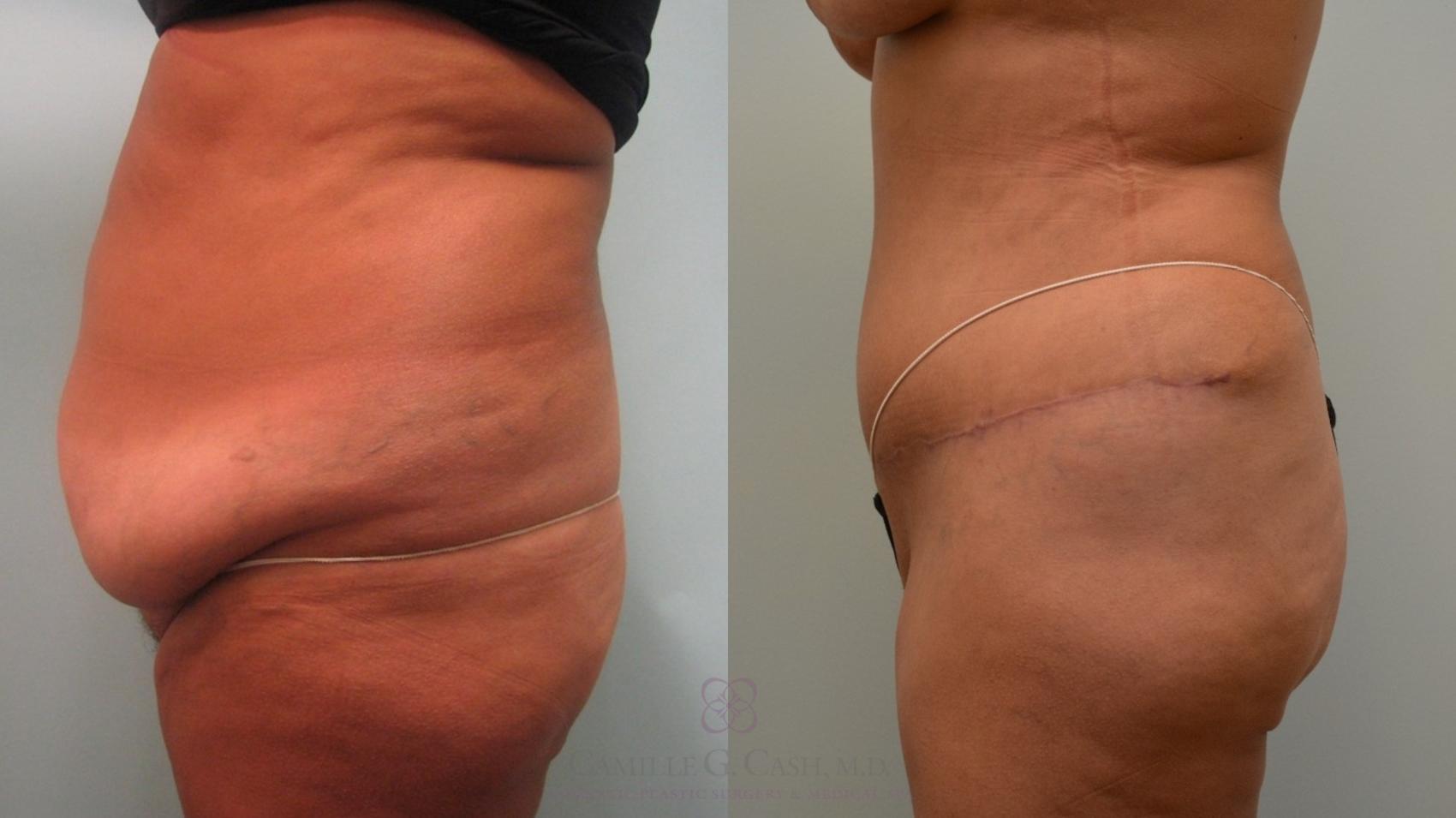 Before & After Tummy Tuck Case 64 Right Side View in Houston, TX