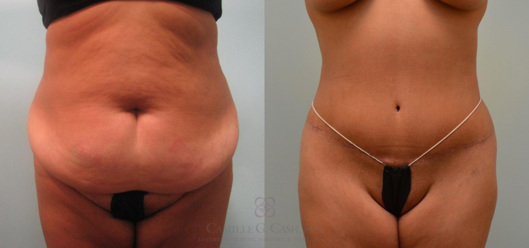 Before & After Tummy Tuck Case 64 View #1 View in Houston, TX