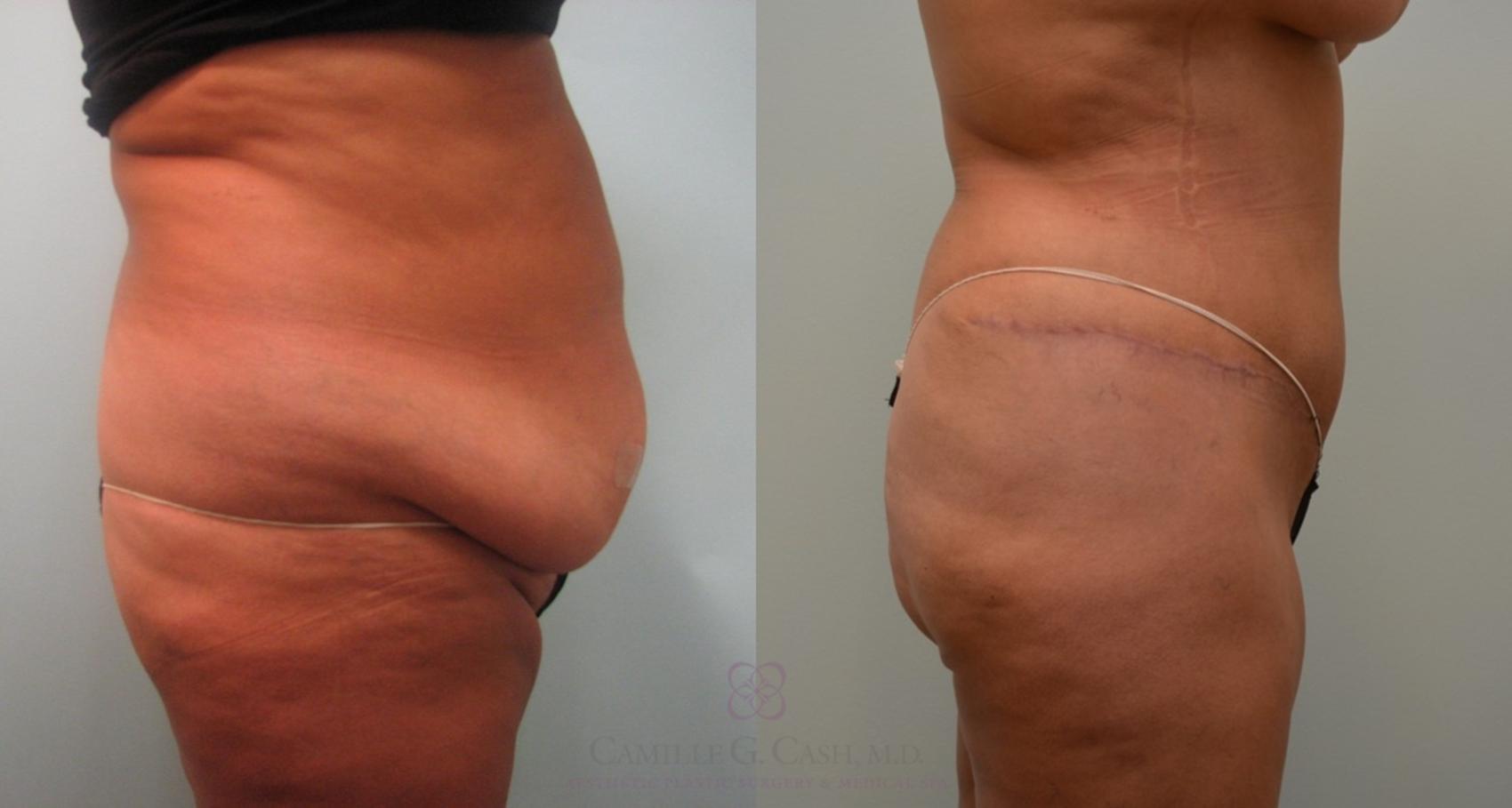 Before & After Tummy Tuck Case 64 View #2 View in Houston, TX