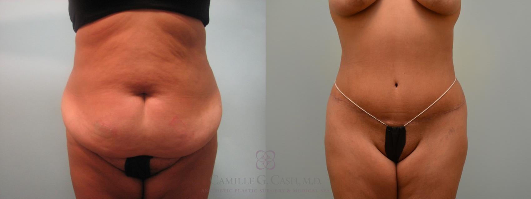 Before & After Tummy Tuck Case 64 View #3 View in Houston, TX