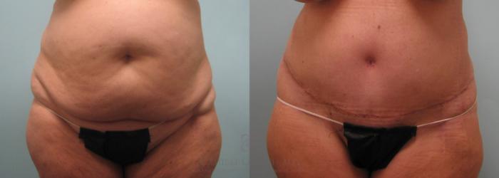 Before & After Tummy Tuck Case 65 View #1 View in Houston, TX