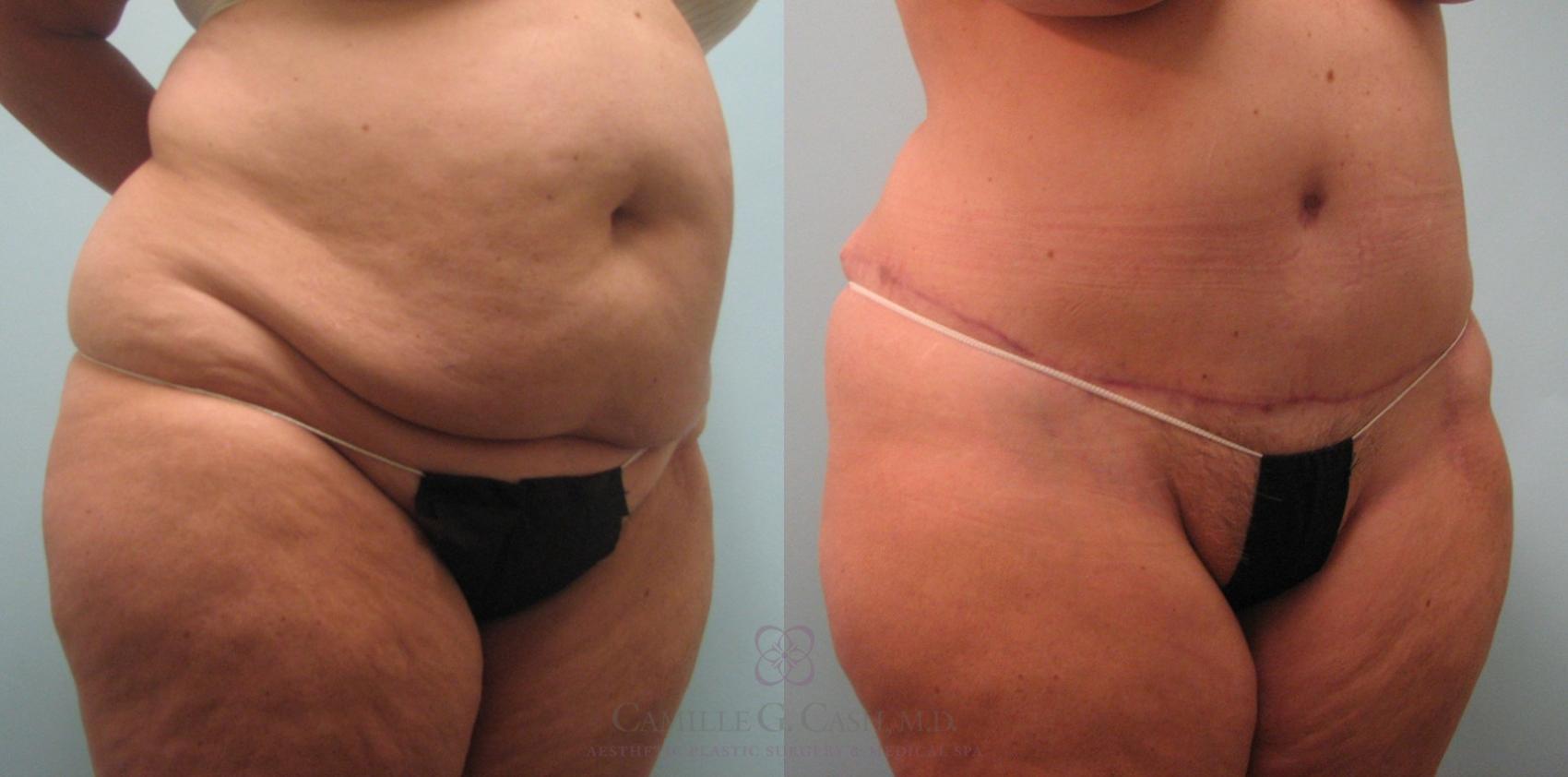 Before & After Tummy Tuck Case 65 View #2 View in Houston, TX