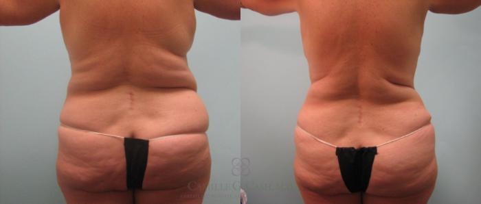 Before & After Tummy Tuck Case 65 View #3 View in Houston, TX