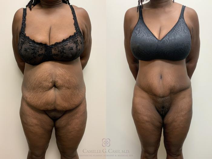 Before & After Liposuction Case 675 Front View in Houston, TX