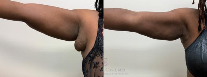 Before & After Liposuction Case 675 left arm View in Houston, TX