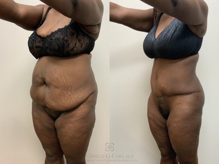 Before & After Tummy Tuck Case 675 Left Oblique View in Houston, TX