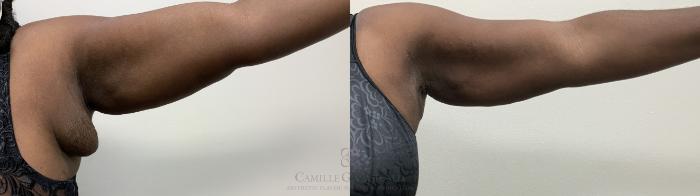 Before & After Liposuction Case 675 right arm View in Houston, TX