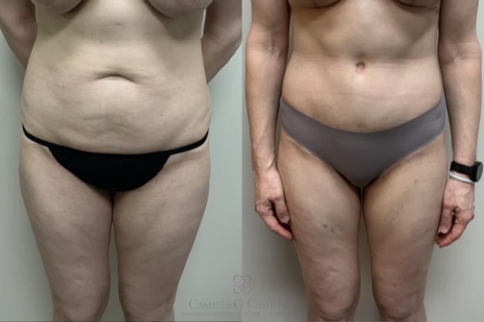 Before & After Tummy Tuck Case 689 Front View in Houston, TX