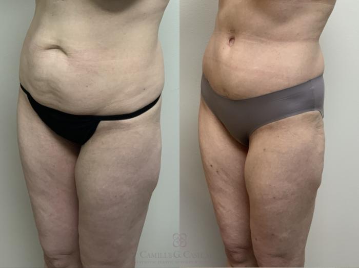Before & After Tummy Tuck Case 689 Left Oblique View in Houston, TX