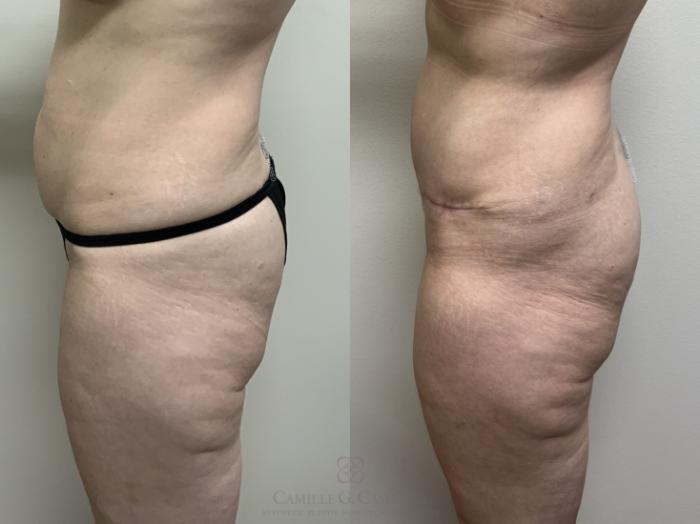 Before & After Tummy Tuck Case 689 Left Side View in Houston, TX